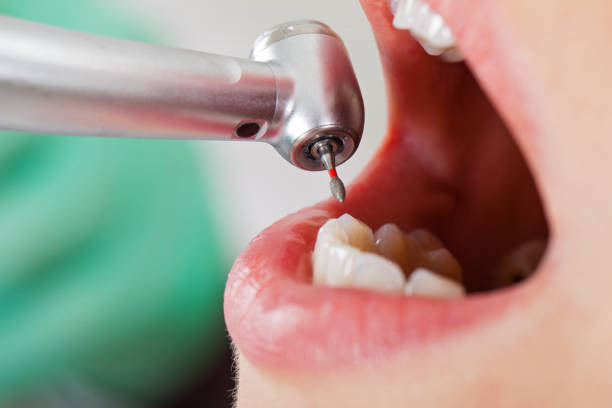 Teeth Whitening in OH